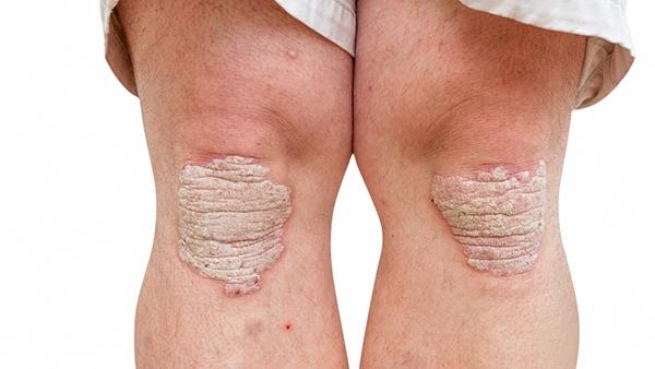 Cara Tepat Menangani Eczema Dan Psoriasis Womantalk