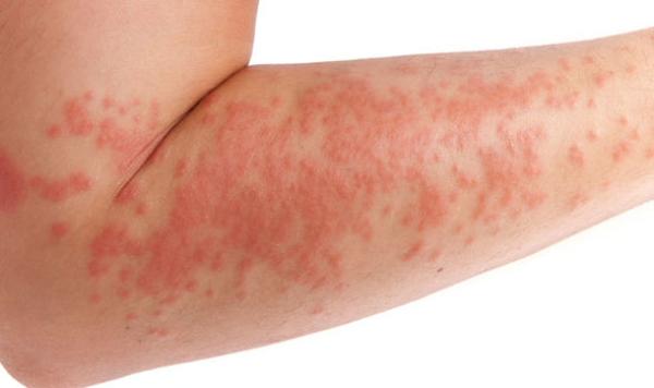 Ini Perbedaan Antara Eczema Dan Psoriasis Womantalk